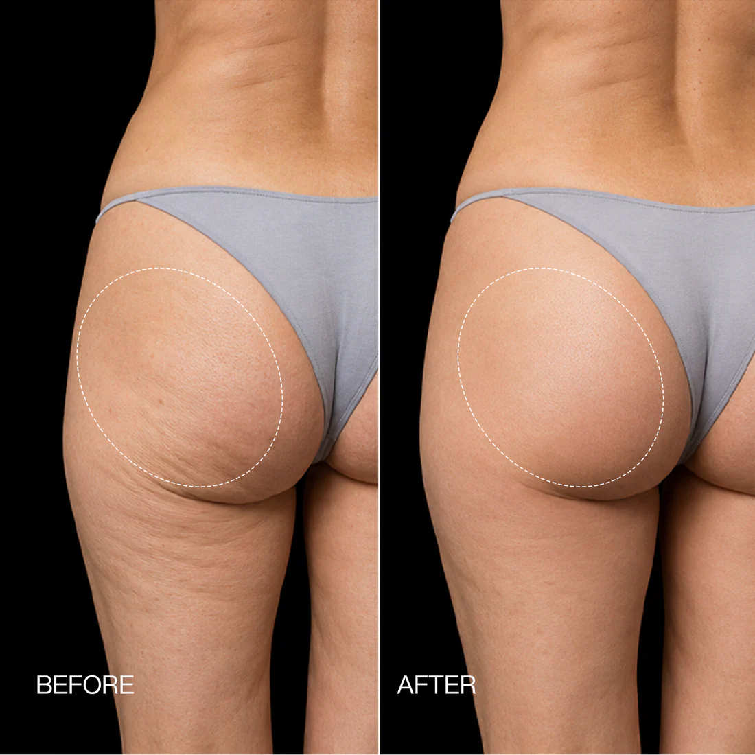 Neravio EMS Toning Shorts